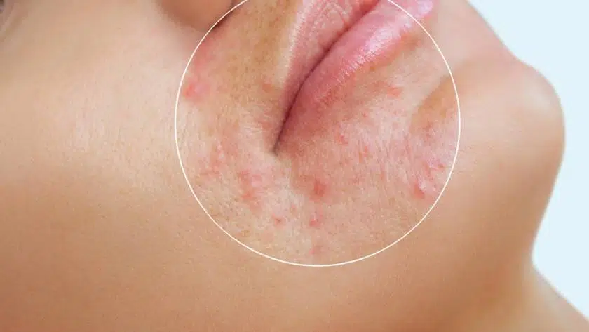 exc.beauty-medizin-akneentfernung