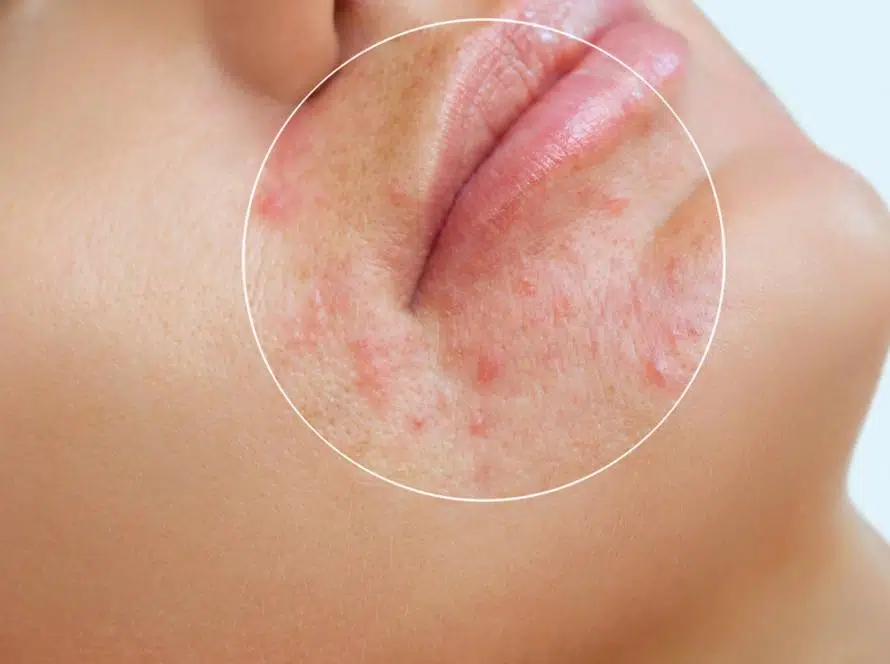 exc.beauty-medizin-akneentfernung